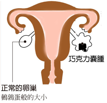 你的卵巢早衰了吗,你的卵巢