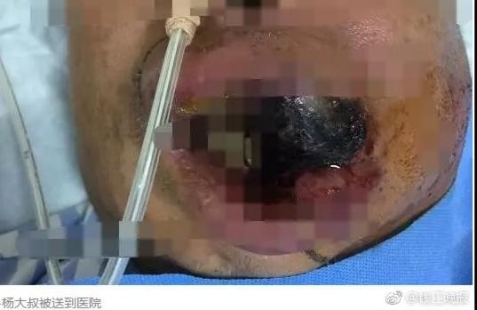 一颗痘引发的惨案,50岁大叔突发心梗命悬一线