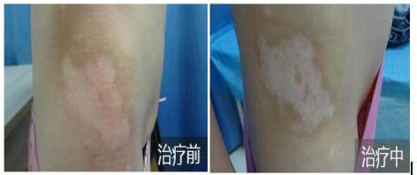 劝告：我现在就告诉你这样追求美，白癜风肯定会恋上你