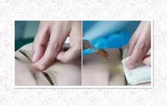 天生歪鼻做隆鼻术后还会变歪吗,隆鼻手术后鼻子歪了图片