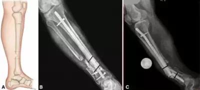 骨折多月了始终不愈合?!骨不连的危害真的有这么大?!