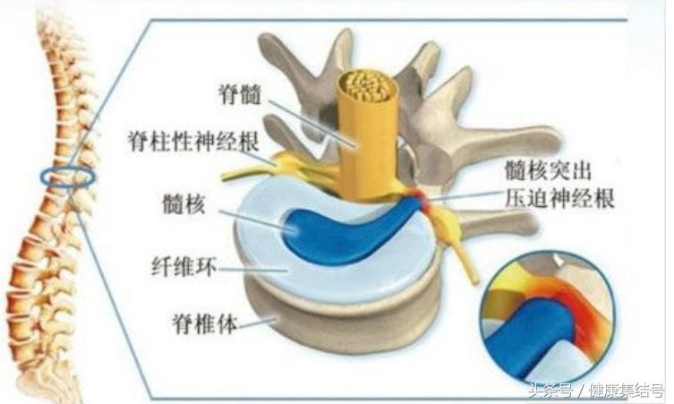腰痛为什么要注意保暖,常见腰痛的原因及自我治疗