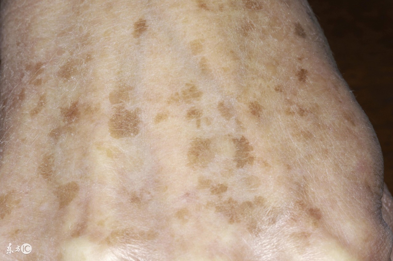 美容科医生汤爱荣:年轻人防止老年斑,这8招管用!