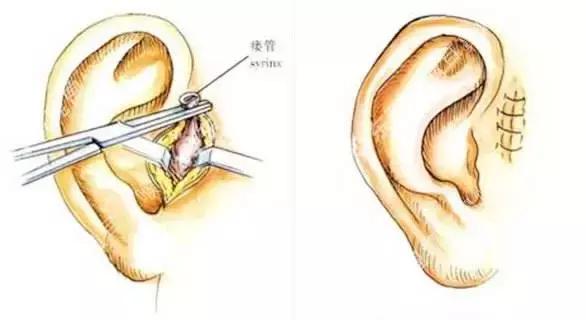 耳朵附近的小孔是什么,耳朵上有聪明嵴真的就聪明吗