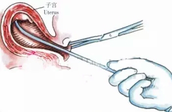 引产和无痛人流哪个危害大,引产不清宫是不是伤害没有那么大