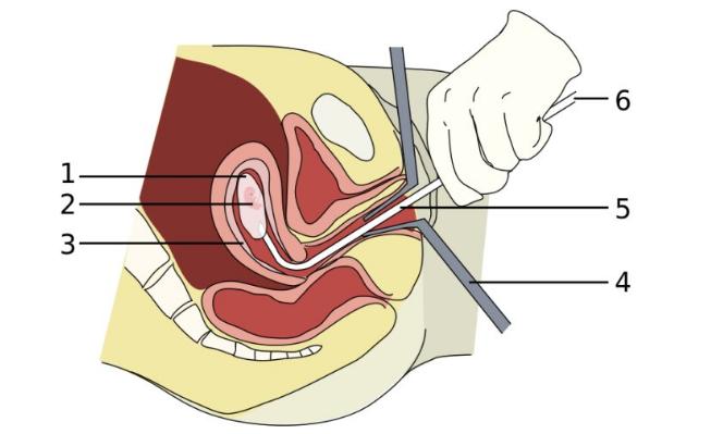 女人一生最多能承受几次生产,女人一生最多能承受几次剖宫产