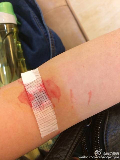 献血后的淤青多久消除,献血后的淤青