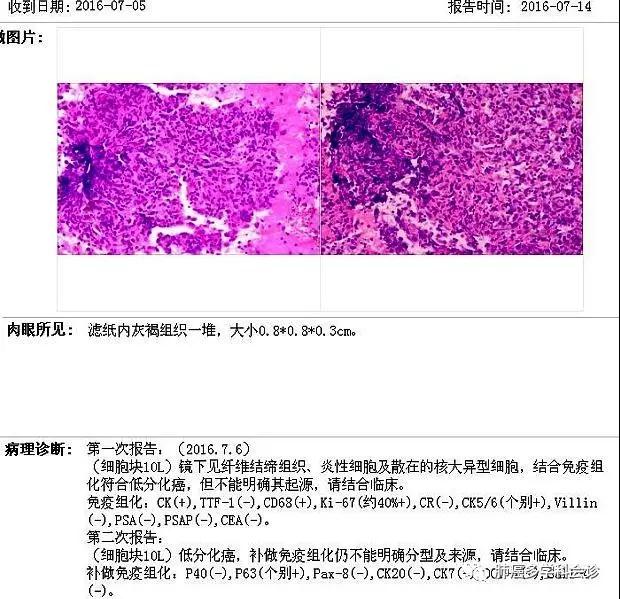 肺癌krasg12d基因突变生存期,肺癌krasg13c基因突变