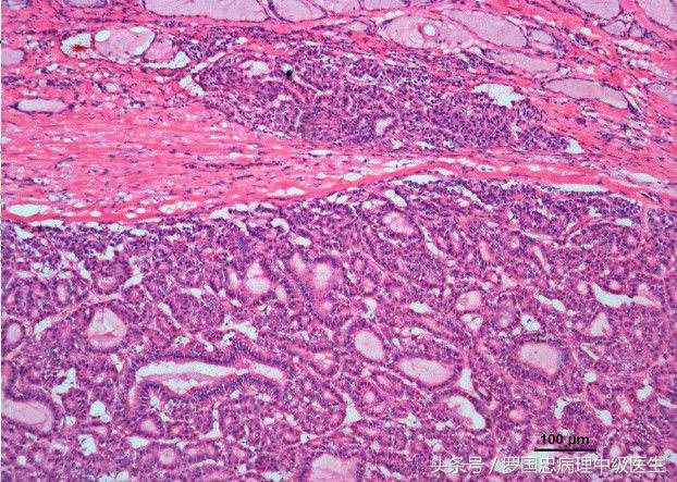 朱迅得甲状腺癌严重吗,祝朱迅早日战胜病魔早日康复