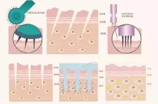 微针治痘有什么功效,微针治痤疮效果好吗