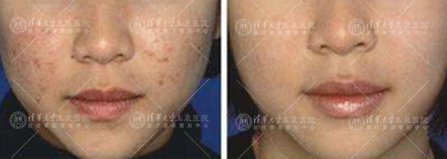 微针治痘有什么功效,微针治痤疮效果好吗