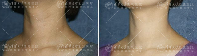 微针治痘有什么功效,微针治痤疮效果好吗