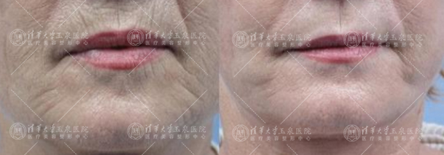 微针治痘有什么功效,微针治痤疮效果好吗