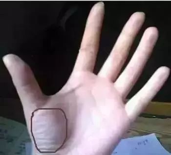 拔罐都是水泡怎么回事,身上湿气重拔罐有水泡