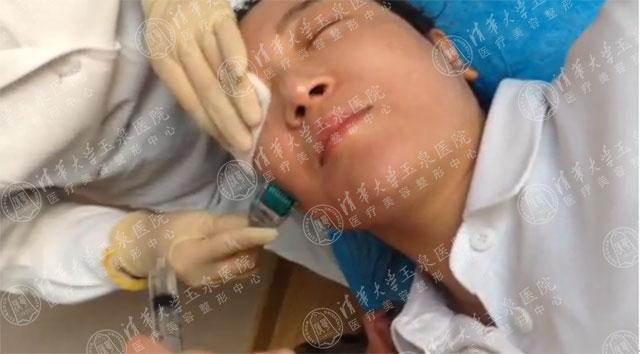 微针治痘有什么功效,微针治痤疮效果好吗