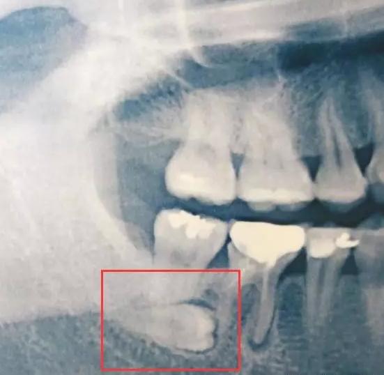 拔智齿后不能打喷嚏为什么,拔智齿后吐口水很疼怎么回事