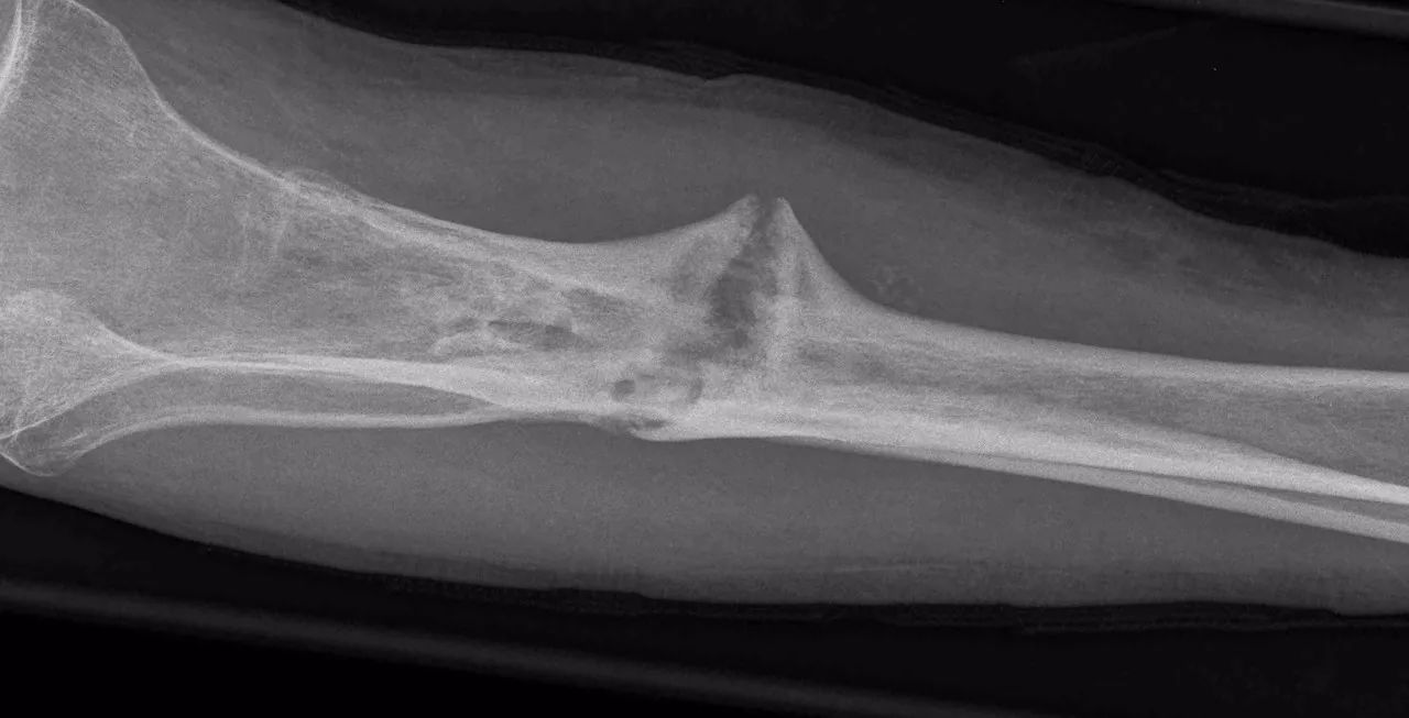 苏联发明断骨增高术,骨科医生神奇疗法