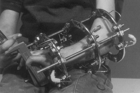 苏联发明断骨增高术,骨科医生神奇疗法