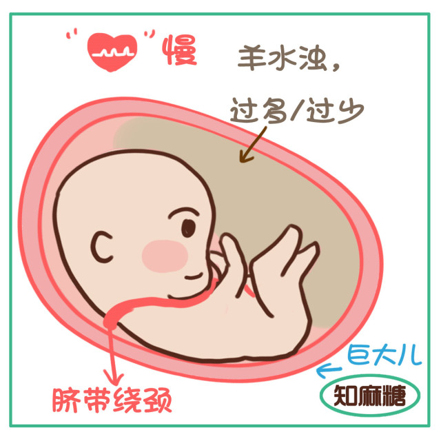 剖腹产必须知道的几件事,剖腹产一定要知道的事情