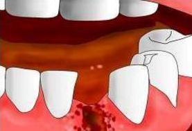 拔智齿后不能打喷嚏为什么,拔智齿后吐口水很疼怎么回事