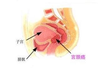 宫颈癌前筛查你做了吗？