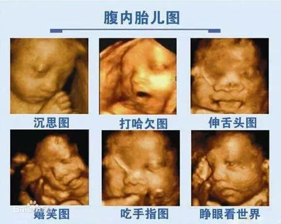四维彩超——为腹中的胎儿“拍美照”