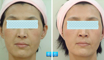 光子嫩肤的认识,光子嫩肤的介绍