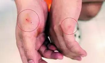 被猫咬伤要打狂犬疫苗吗,自家宠物猫抓伤需要打狂犬疫苗吗