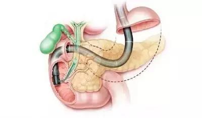 它是“癌中之王”，如何远离？推荐2款药膳