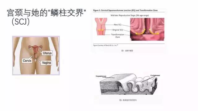 宫颈糜烂不是病治疗千万别乱来,正确认识宫颈糜烂避免过度治疗