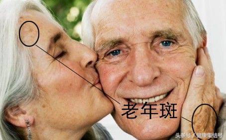 色斑的治疗方法,色斑分为哪几种怎么做可以淡化