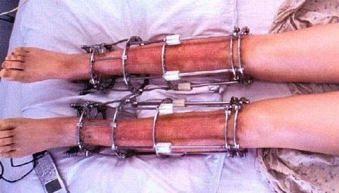 苏联发明断骨增高术,骨科医生神奇疗法