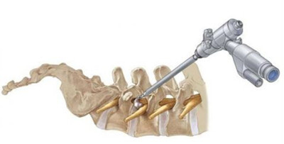 四川省骨科医院颈椎病专家有哪些,骨科颈椎病治疗方法