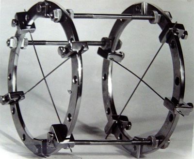 苏联发明断骨增高术,骨科医生神奇疗法