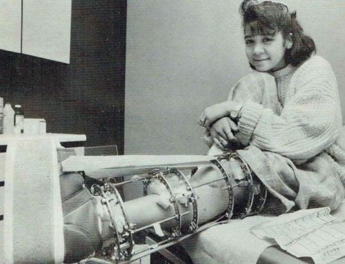 苏联发明断骨增高术,骨科医生神奇疗法