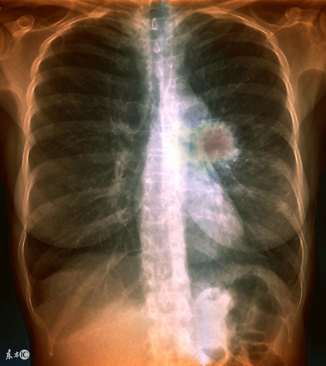 治疗肺结核用药的原则是什么,肺结核药物治疗原则