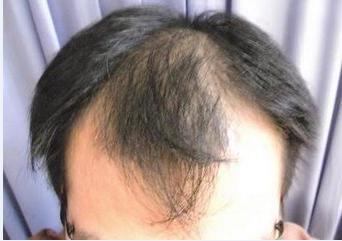 治疗脂溢性脱发的药,一招解决脂溢性脱发