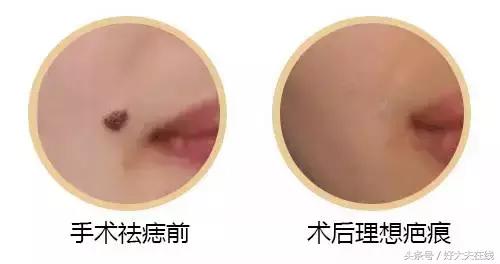 脸部受伤怎么不留疤和修复,受伤后如何不留疤痕