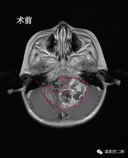 2岁宝宝脑袋有肿瘤有什么症状,2岁小孩先天性脑肿瘤