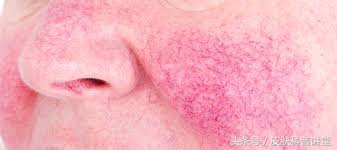 酒渣鼻玫瑰座疮用什么药膏,酒渣鼻玫瑰痤疮能自愈吗