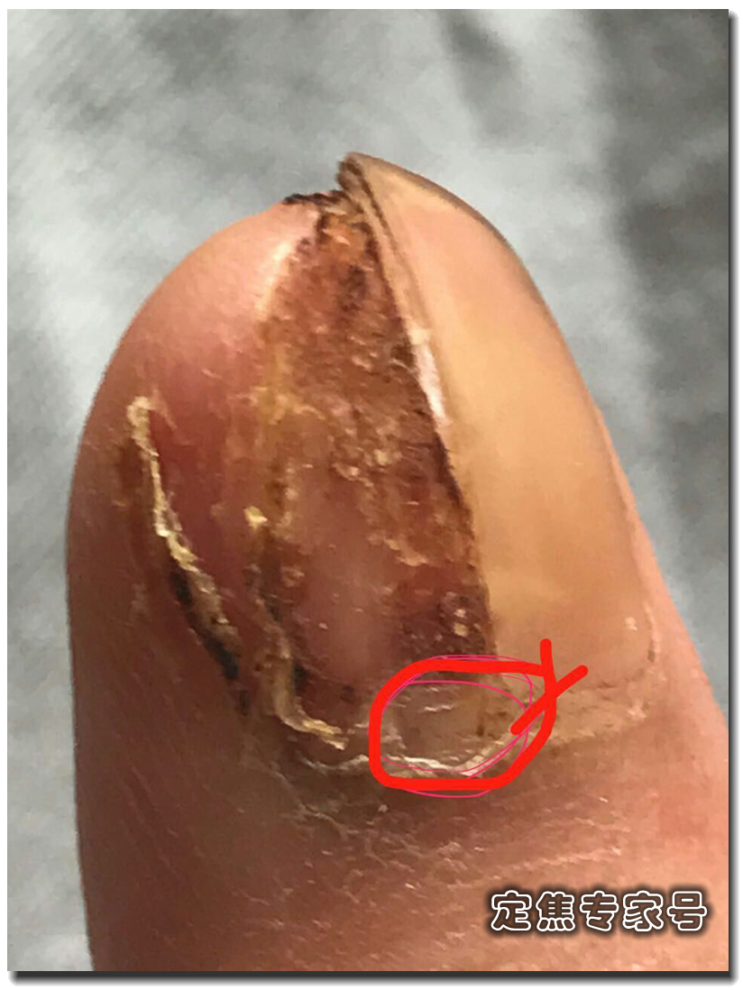 黑痣也算痣吗,怎么判断天生黑痣是好的坏的