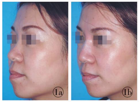 隆鼻最安全的是哪种隆鼻方法啊,隆鼻技术现在成熟了吗