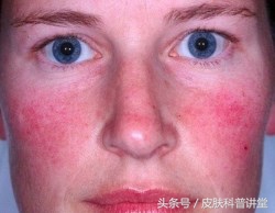 酒渣鼻玫瑰座疮用什么药膏,酒渣鼻玫瑰痤疮能自愈吗