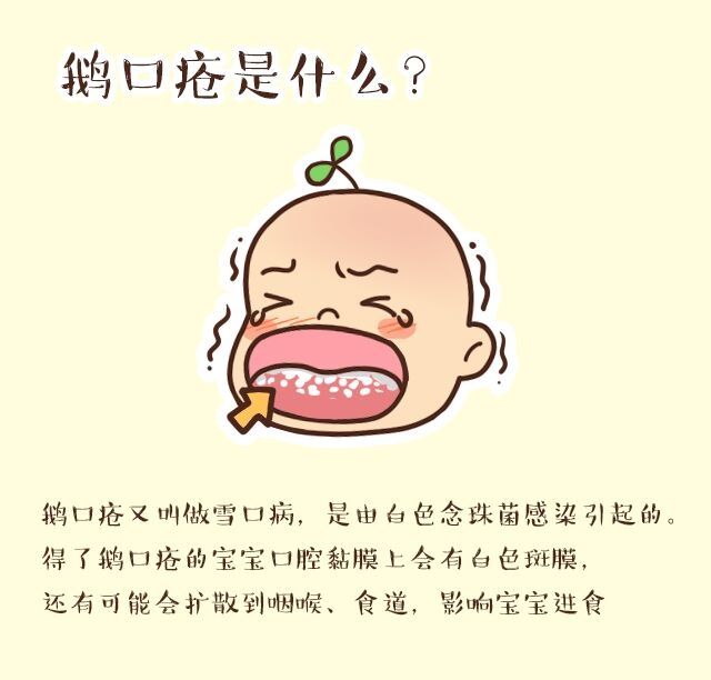 氟康唑胶囊治疗鹅口疮的使用方法,婴儿鹅口疮最快的解决方法