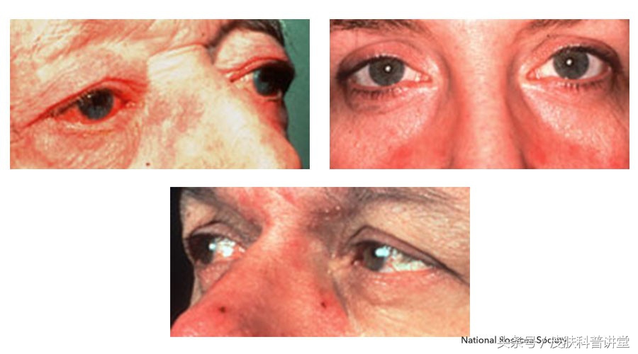 酒渣鼻玫瑰座疮用什么药膏,酒渣鼻玫瑰痤疮能自愈吗