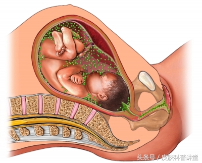 胎传梅毒诊断标准,胎传梅毒能彻底治愈吗