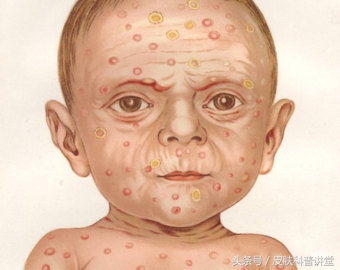 胎传梅毒诊断标准,胎传梅毒能彻底治愈吗