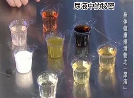 通过尿液判断疾病,自己的尿液能看出来癌症吗