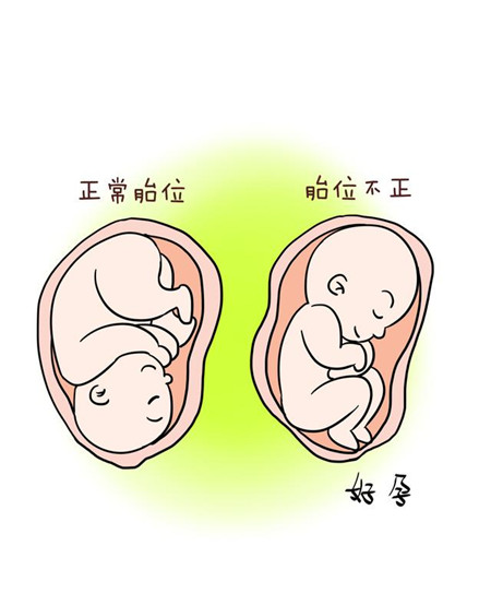 怀孕33胎位不正怎样才能纠正,怀孕胎位不正脐带绕颈一周怎么办