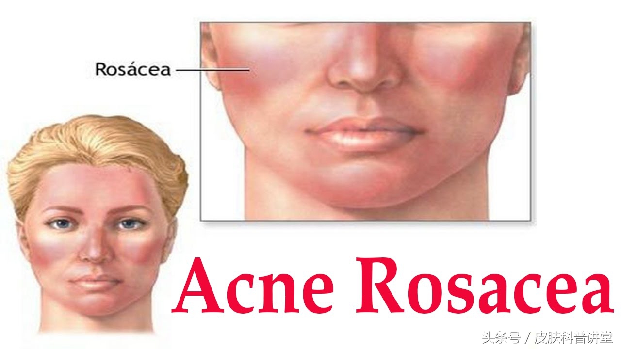 酒渣鼻玫瑰座疮用什么药膏,酒渣鼻玫瑰痤疮能自愈吗